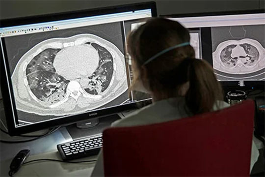 Կորոնավիրուսով վարակվածների թոքերում ախտահարումներ են հայտնաբերվել նաև հիվանդության առանց ախտանշանների ընթացքի դեպքում. Lenta.ru
